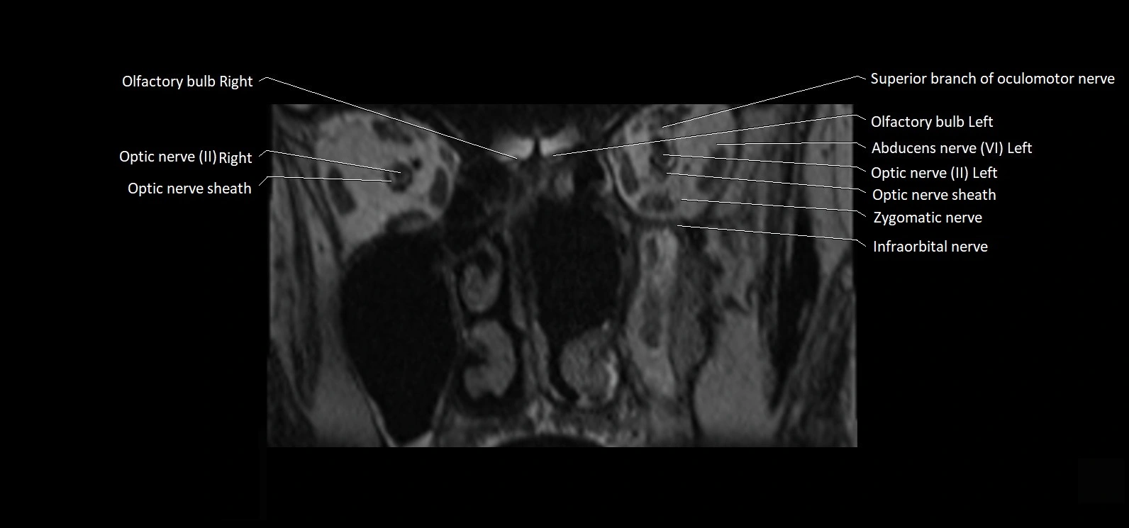Cranial nerve cross sectional anatomy coronal 3T MRI image 6.webp